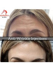 Treatment for Wrinkles - Aesthetics by Silvie
