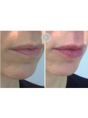 Lip Augmentation - Avika Aesthetics