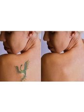 Tattoo Removal - Diamond Skin Aesthetic and Laser Clinic