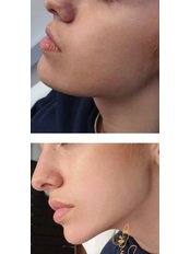 Jawline Slimming - Diamond Skin Aesthetic and Laser Clinic