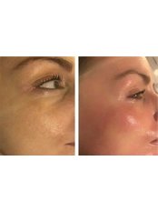Microneedling - Diamond Skin Aesthetic and Laser Clinic