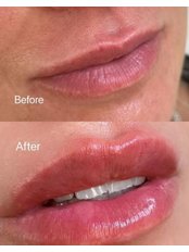 Lip Augmentation - Diamond Skin Aesthetic and Laser Clinic