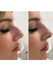 Non-Surgical Nose Job - Diamond Skin Aesthetic and Laser Clinic