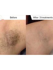 Laser Hair Removal - Diamond Skin Aesthetic and Laser Clinic