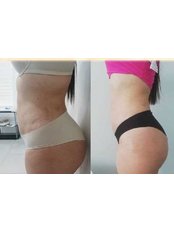 CoolSculpting® - Diamond Skin Aesthetic and Laser Clinic
