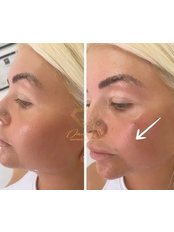 Cheek Augmentation - Diamond Skin Aesthetic and Laser Clinic