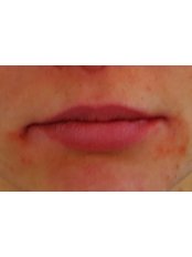 Lip Augmentation - Intoskin