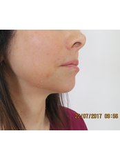Chin Augmentation - Intoskin