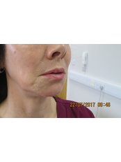 Chin Augmentation - Intoskin