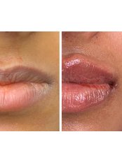 Lip Augmentation - AS Allure Aesthetics