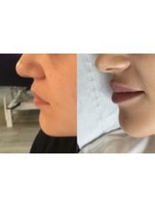 Lip Augmentation - Asthetik London Skin Clinic