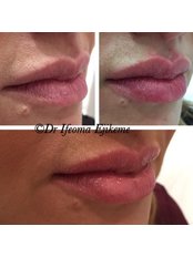 Lip Augmentation - Adonia Medical Clinic