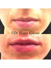 Lip Augmentation - Adonia Medical Clinic