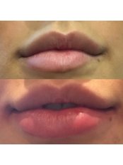 Lip Augmentation - The Peer Clinic