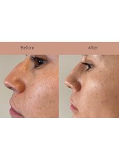 Non-Surgical Nose Job - Vanessa Charest Aesthetic