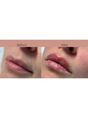 Lip Augmentation - Vanessa Charest Aesthetic