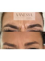 Anti Wrinkle Injections - Vanessa Charest Aesthetic