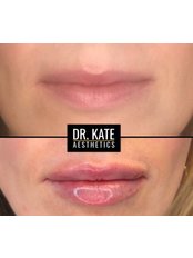 Lip Augmentation - Dr Kate Aesthetics
