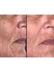 Treatment for Wrinkles - Dr Kate Aesthetics
