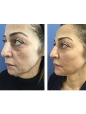 Treatment for Wrinkles- 1 Area - Ambra Aesthetic Clinic
