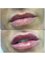 Bloom Aesthetics & Beauty Clinic - Lip filler 