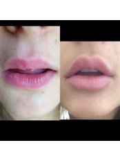 Lip Augmentation - RP Facial rejuvenation