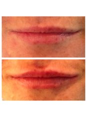Lip Augmentation - RP Facial rejuvenation