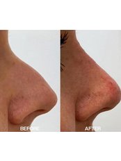 Non-Surgical Nose Job - Aesthetics of Liverpool
