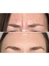 Treatment for Wrinkles - Aesthetics of Liverpool