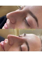 Non-Surgical Nose Job - Allure MediSpa