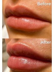 Lip Augmentation - Allure MediSpa