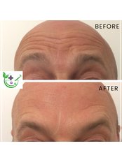 Treatment for Wrinkles - Aesthetics To You