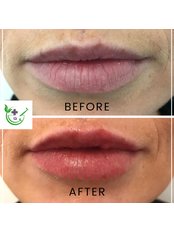Lip Fillers - Aesthetics To You
