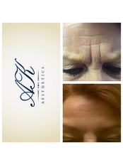 Treatment for Wrinkles - Angela Kerr LTD