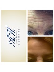 Treatment for Wrinkles - Angela Kerr LTD