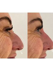 Non-Surgical Nose Job - Skin Solutions