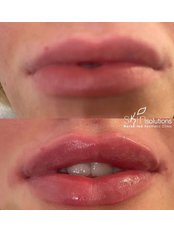 Lip Augmentation - Skin Solutions