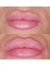 Lip Augmentation - John Parker Aesthetics