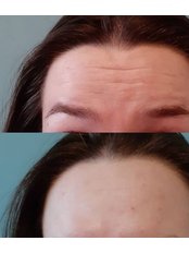 Treatment for Wrinkles - Dr Naz Aesthetics Clinic - Wirral