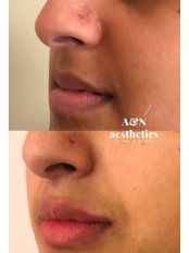 Lip Augmentation - Dr Naz Aesthetics Clinic - Wirral