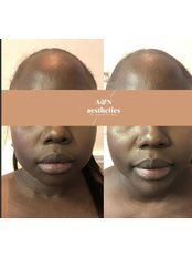 Chin Augmentation - Dr Naz Aesthetics Clinic - Wirral