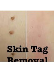 Skin Tag Removal - Jovem