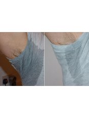 Excessive Sweating Treatment - Visify Aesthetics - The Vale