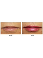 Lip Augmentation - Visify Aesthetics - The Vale