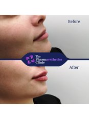 Lip Augmentation - The Pharmaesthetics Clinic