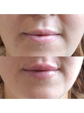 Lip Enhancement  - Hidden Lines Aesthetics