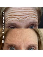 Anti Ageing Injections - Hidden Lines Aesthetics