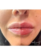 Lip Augmentation - Beauty Secrets Aesthetics