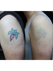 Tattoo Removal - Natrabrow
