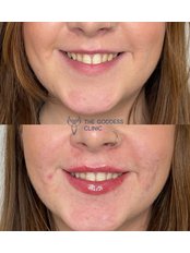 Lip Augmentation - The Goddess Clinic